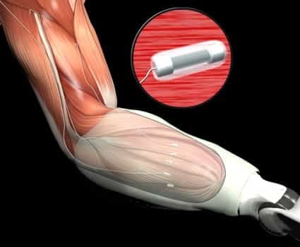 DARPA Implanted Myoelectric Sensors