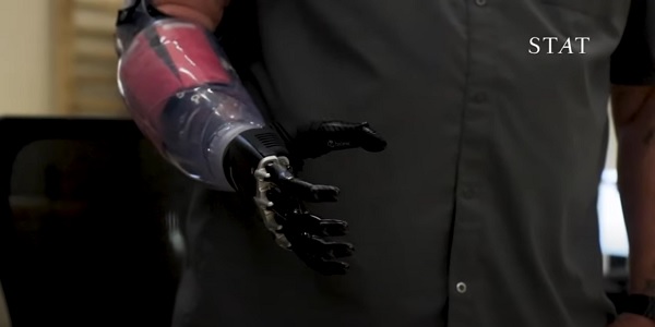 AMI Upper Limb Bionic Video