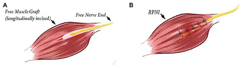 RPNI Muscle Graft