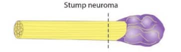 Stump Neuroma