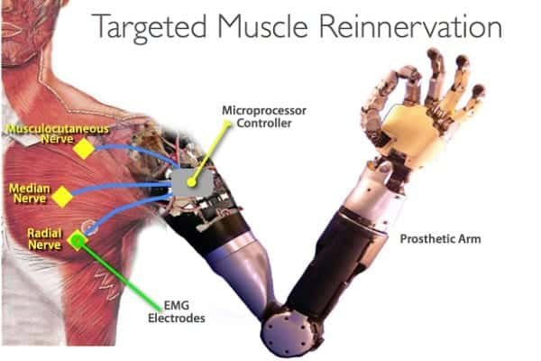 Targeted Muscle Reinnervation Feature Image