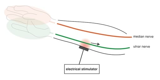 Transcutaneous Electrical Nerve Stimulation Diagram